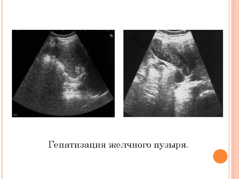 Гепатизация желчного пузыря.